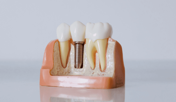 Dental model showing an implant, abutment and crown between natural teeth